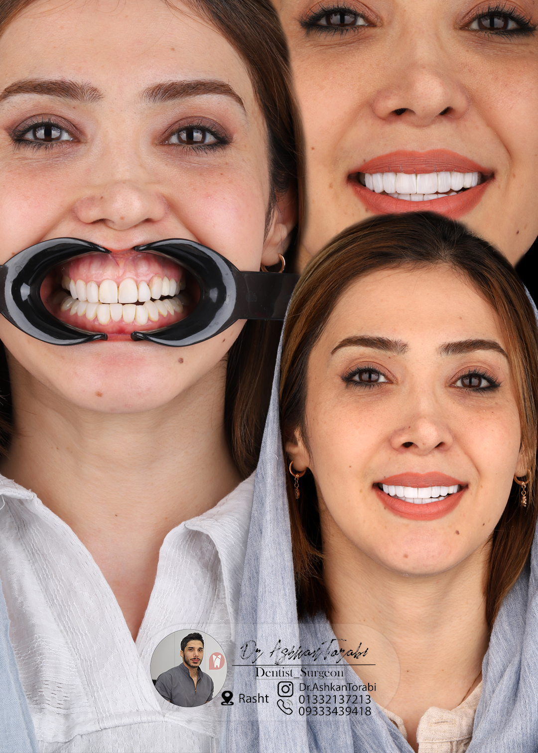 طراحی لبخند